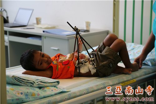 斯里兰卡先天性畸形患儿Delen小朋友